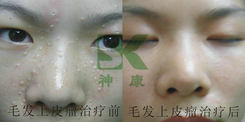 哪里有中醫zl專業zl毛發上皮瘤機構