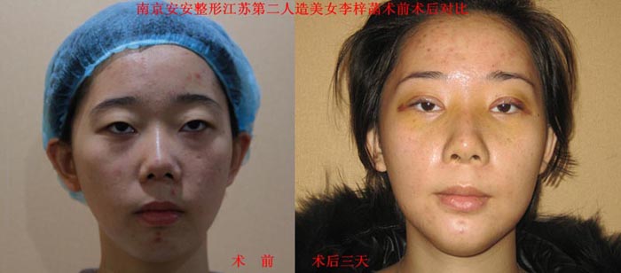 南京美白針微整形