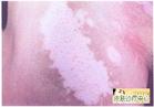 洛陽哪個醫院zl白癜風{zh0}，洛陽白癜風治，洛陽皮膚科