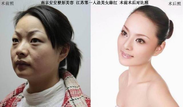 南京安安整形第二人造美女出爐紀實