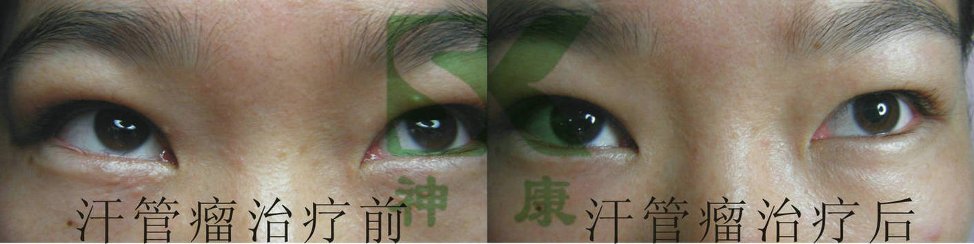 廣州中藥治療治療汗管瘤企業(yè)電話