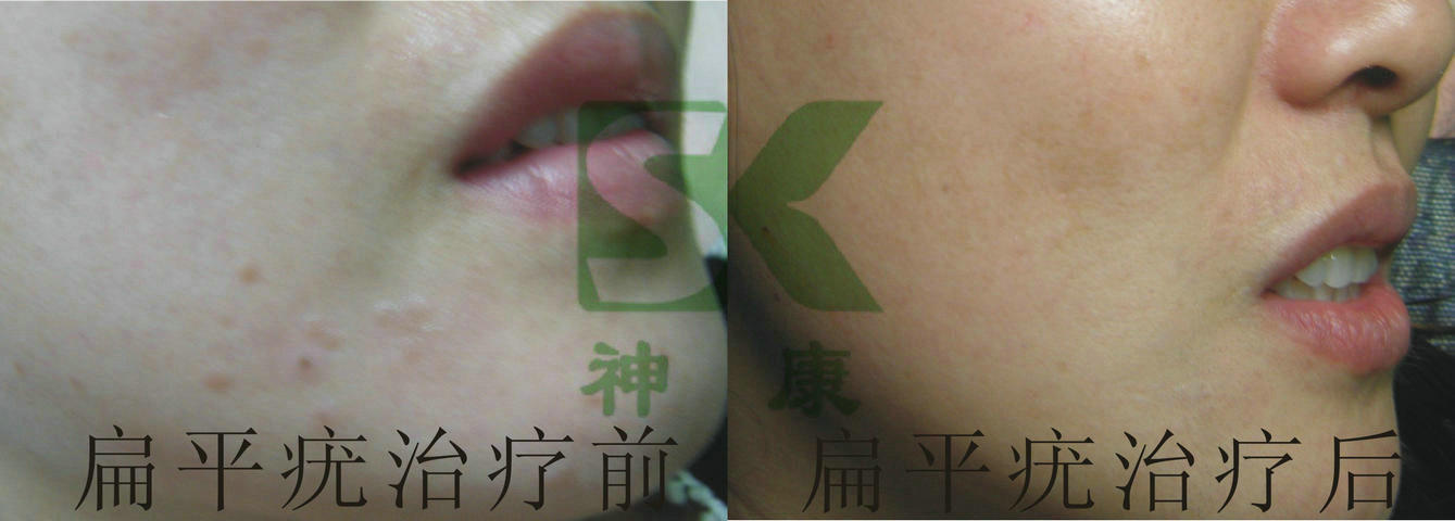 中醫中藥zlzl扁平疣公司地址