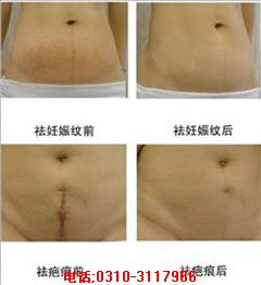 修復(fù)剖腹產(chǎn)bh哪家zzy|祛剖腹產(chǎn)bh哪家好|邯鄲喜麗給您貼心護(hù)理