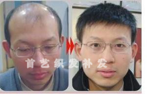 頭發稀少怎么辦？到廣州首藝織發中心找找看