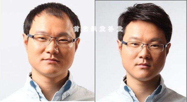 頭發稀少怎么辦？到廣州首藝織發中心找找看